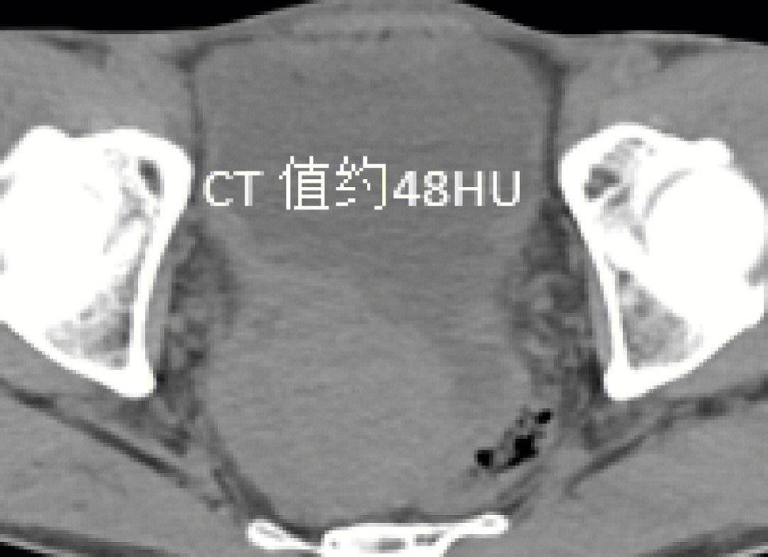 盆腔腹膜间皮瘤上皮型22220136