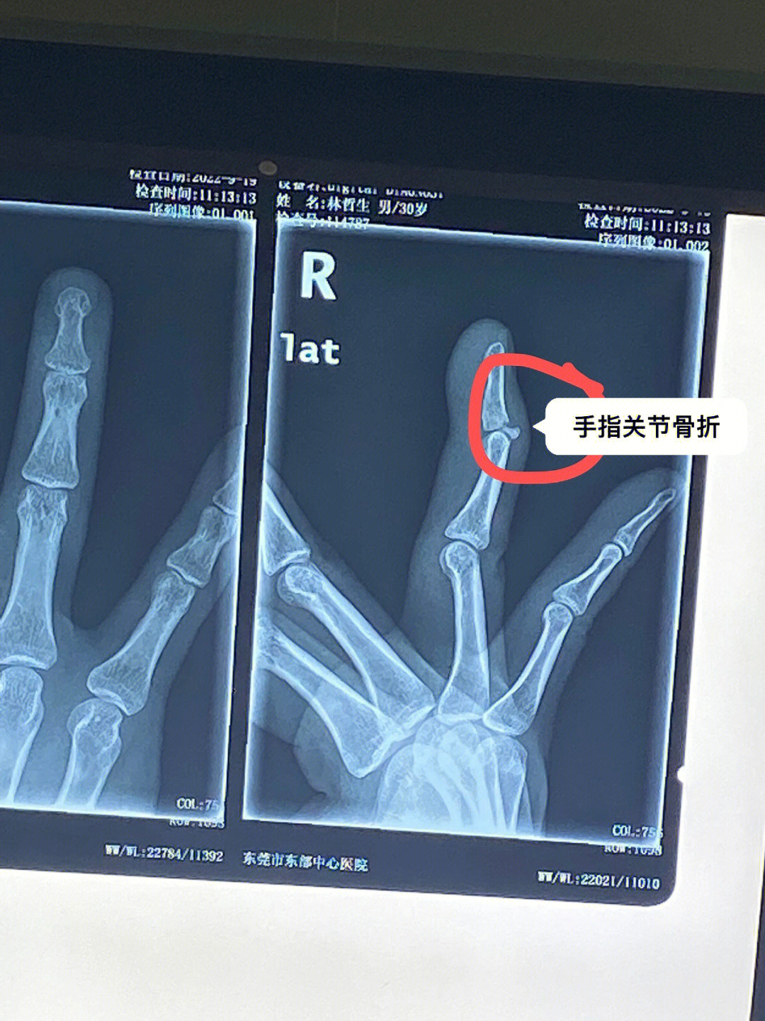 芭比q了手指关节骨折了