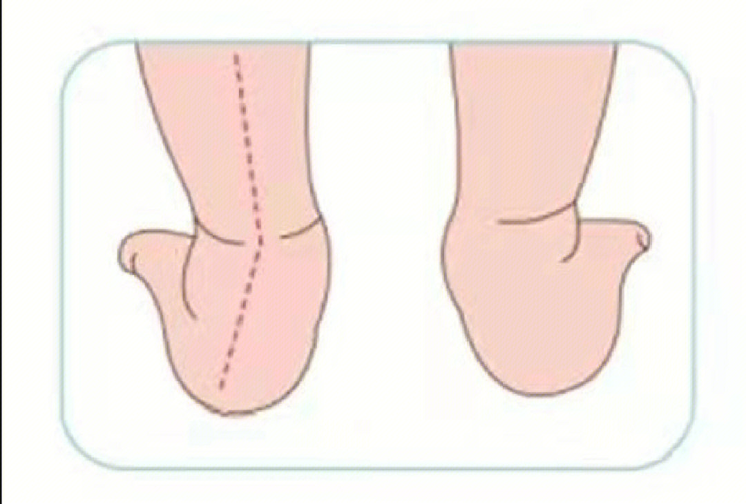 怎样判断宝宝足外翻图片