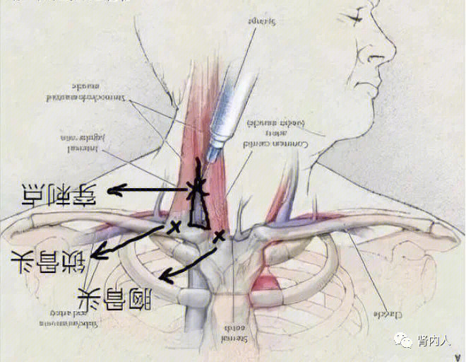 颈静脉穿刺解剖图图片