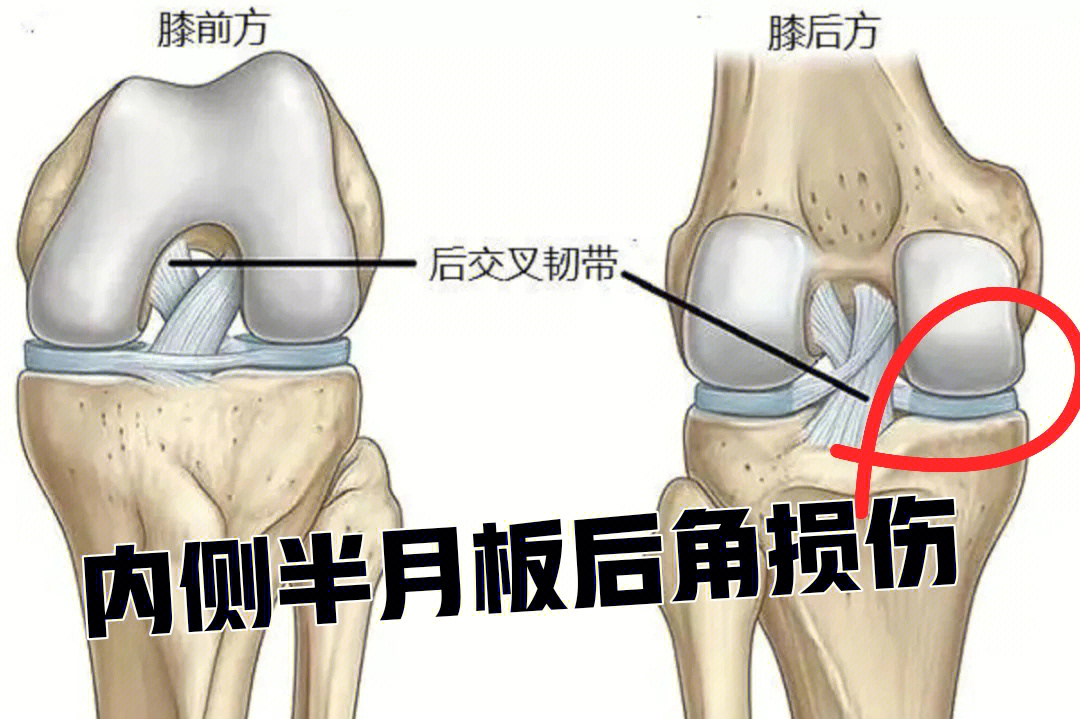 膝关节内侧半月板后角损伤