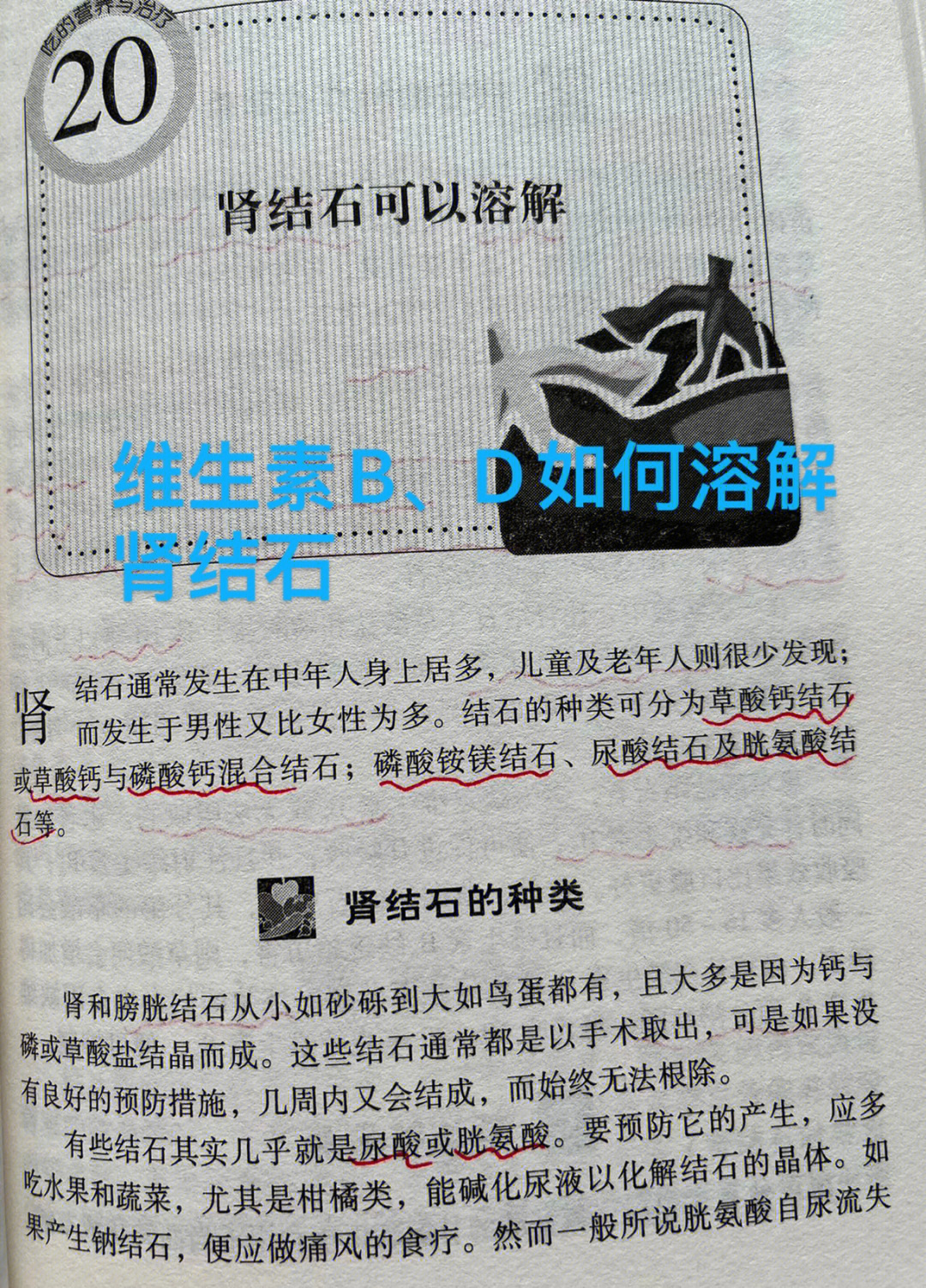 [流汗r]结石的种类可分为草酸钙结石或草酸钙与磷酸钙混合结石,尿酸