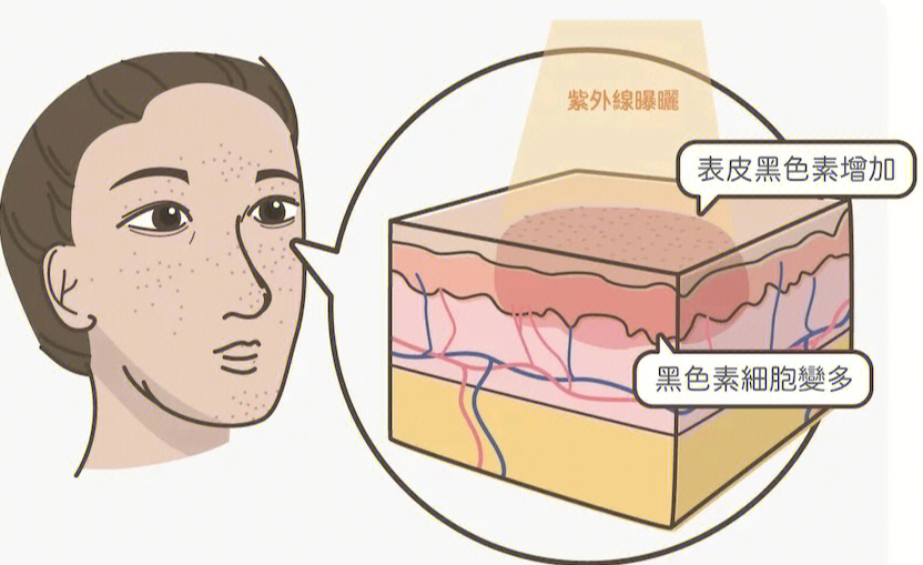 脸部肝斑分布图图片