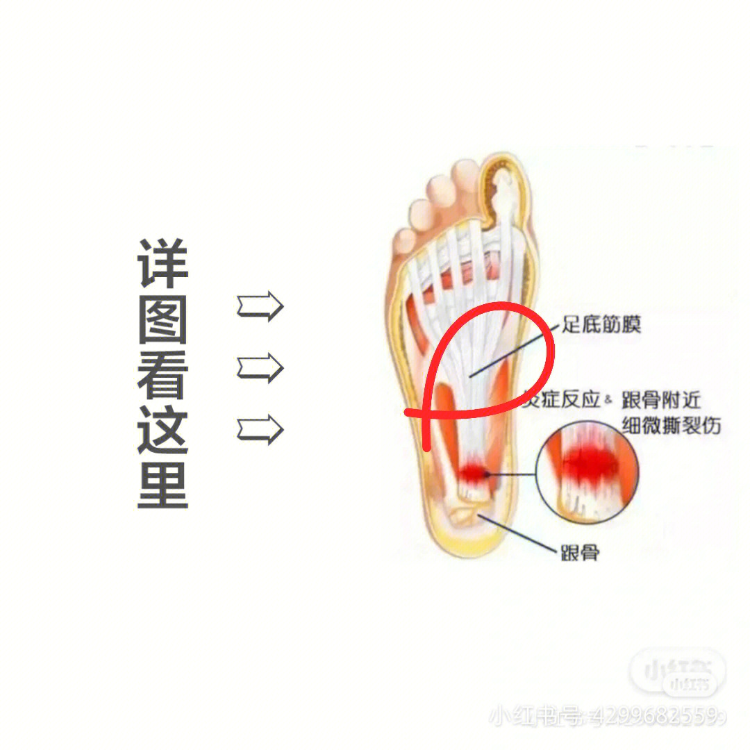 足底筋膜炎4个痛点图片