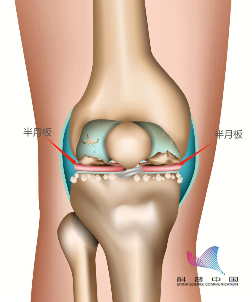 每侧膝关节各自拥有一块内侧半月板和一块外侧半月板