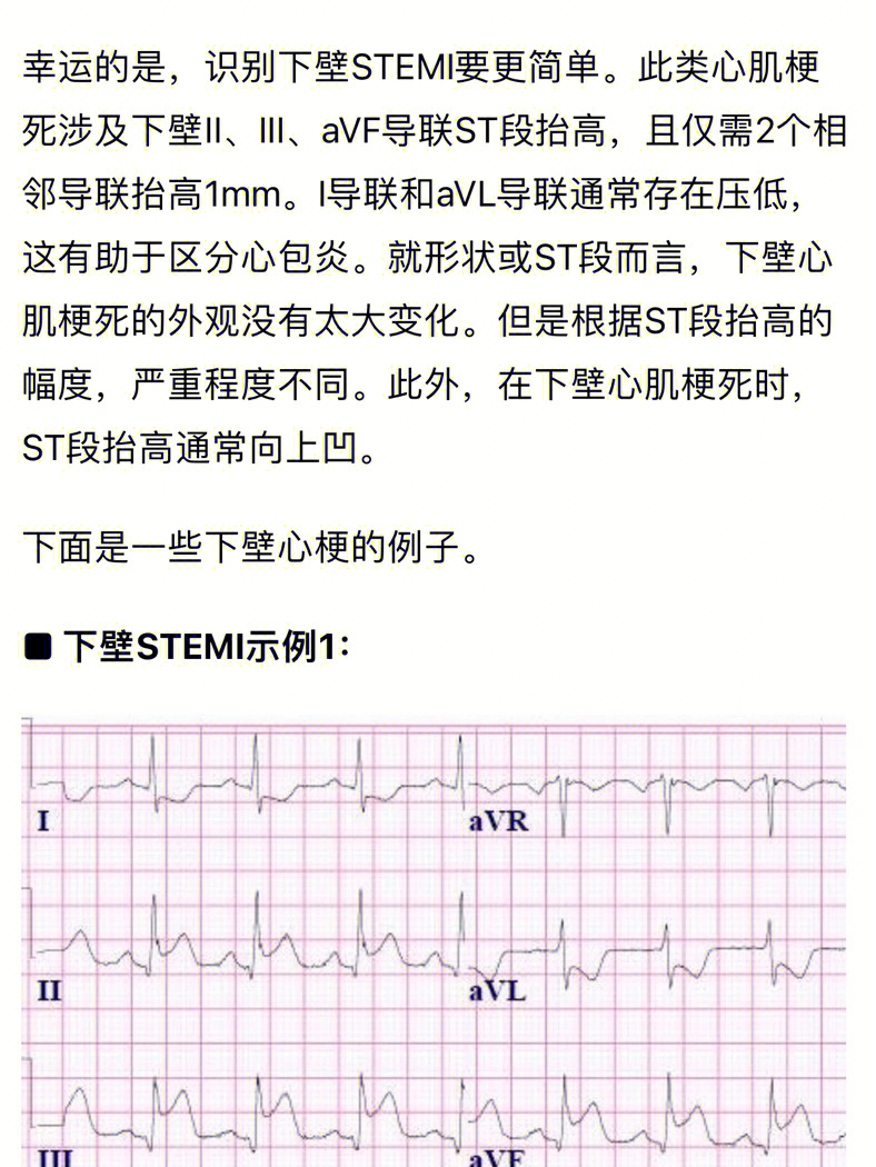 诊断后壁心梗的心电图标准(即使没有明显的st段抬高,其治疗类似于