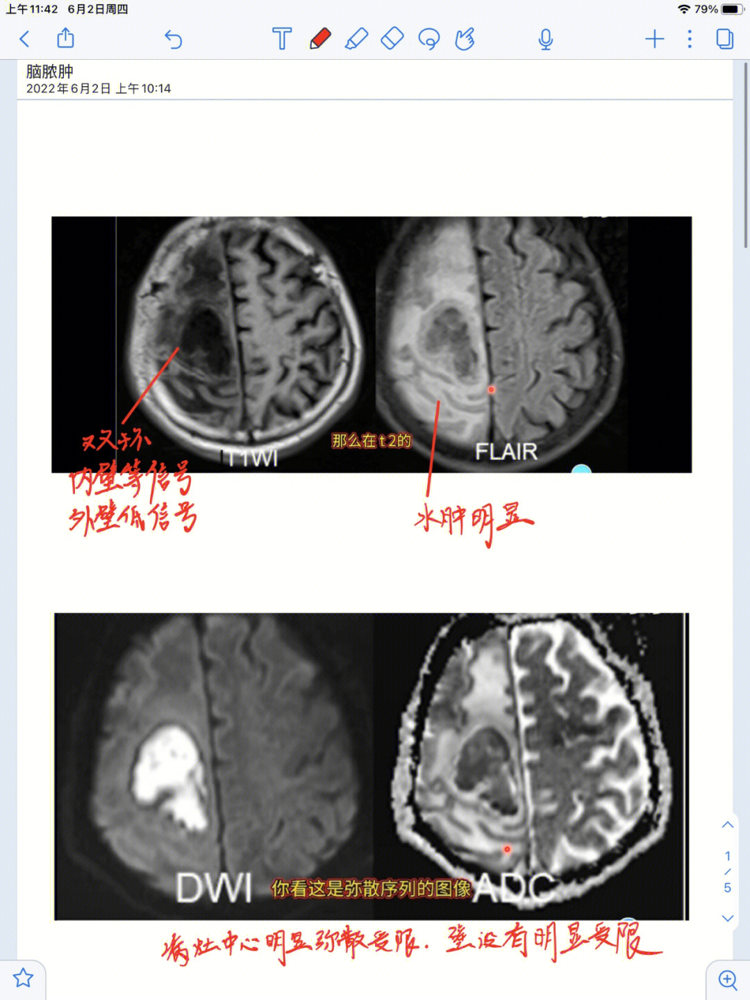 脑脓肿诊断图片