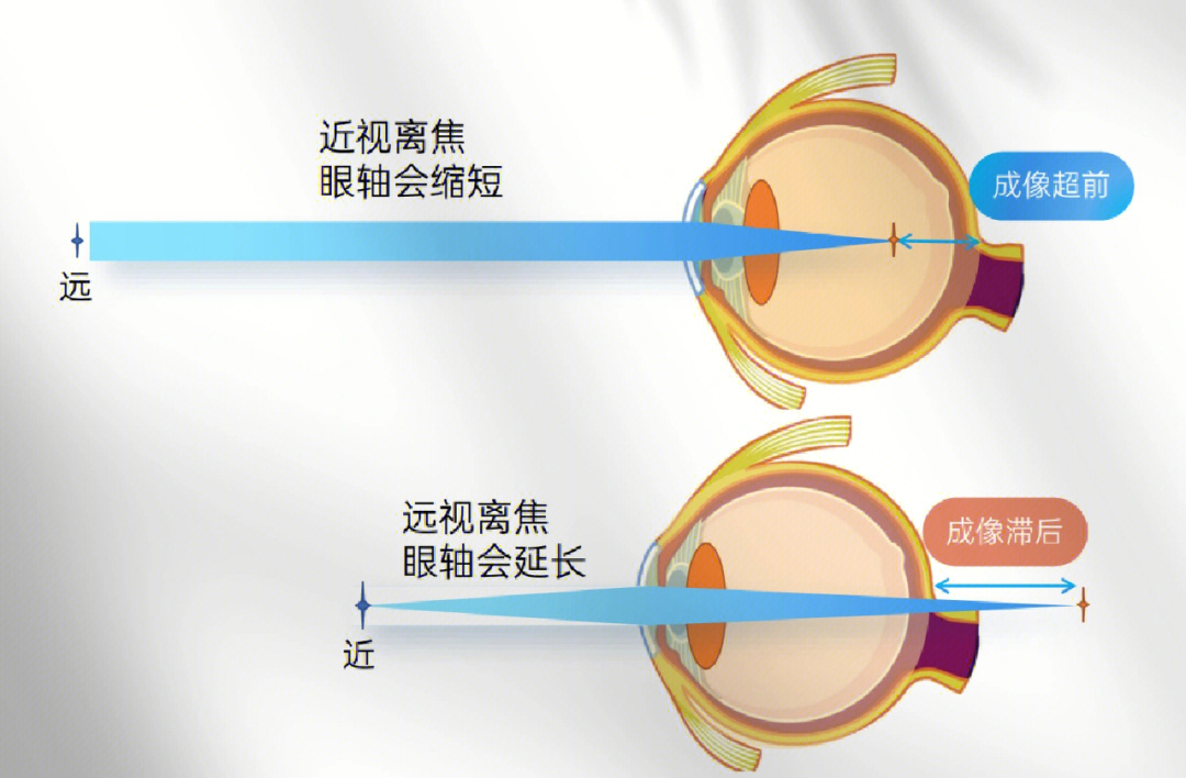 近视眼的成像原理图解图片