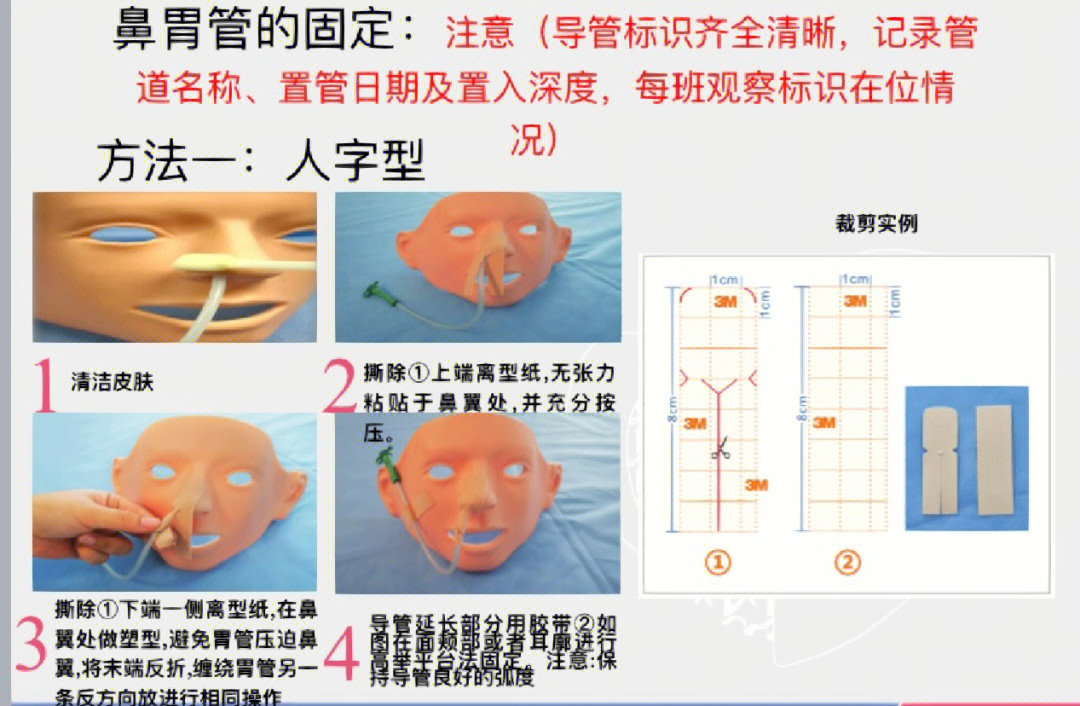 胃管双耳挂绳固定方法图片