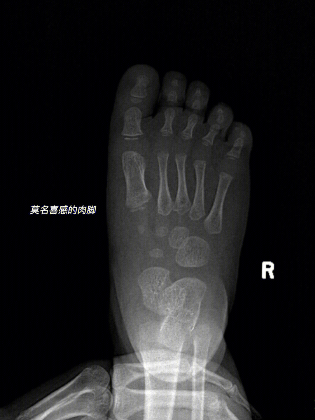 青枝骨折 名词解释图片