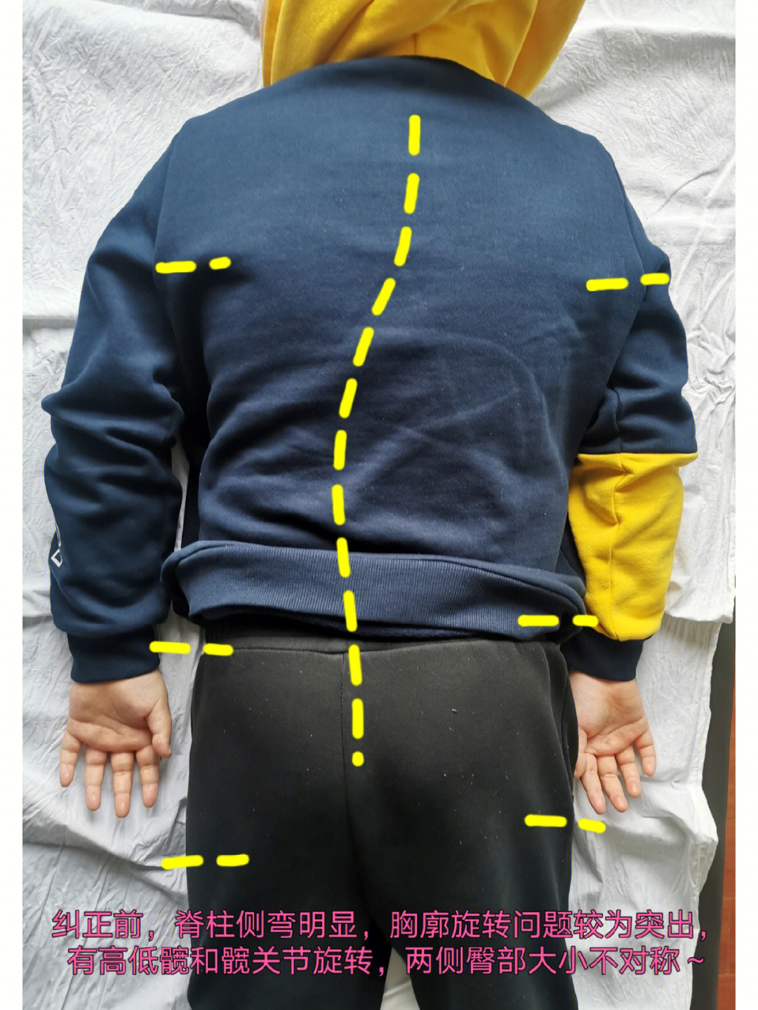 脊柱侧弯较为明显胸廓旋转问题尤为突出～高低髋和髋关节旋转明显