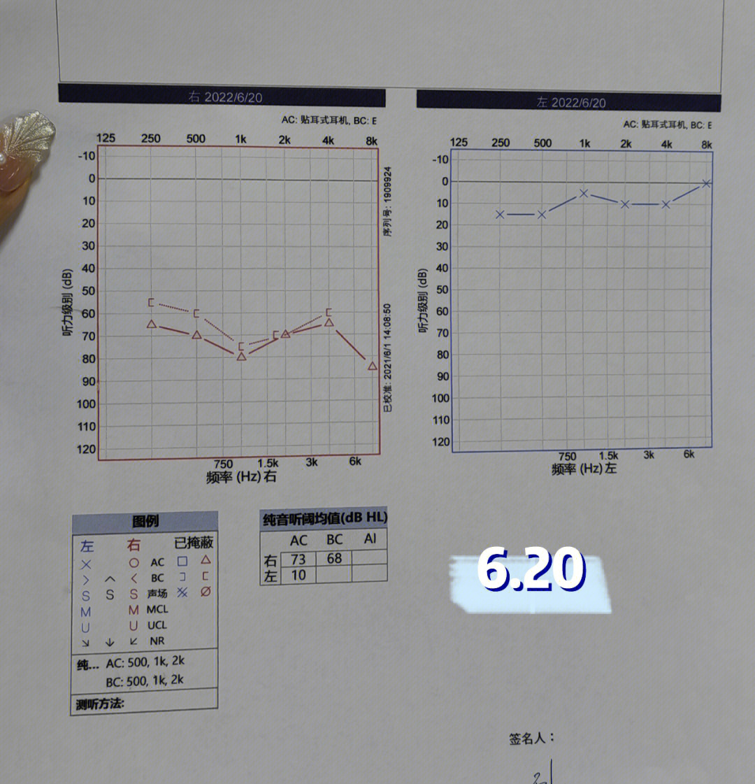 纯音测听报告正常图片图片