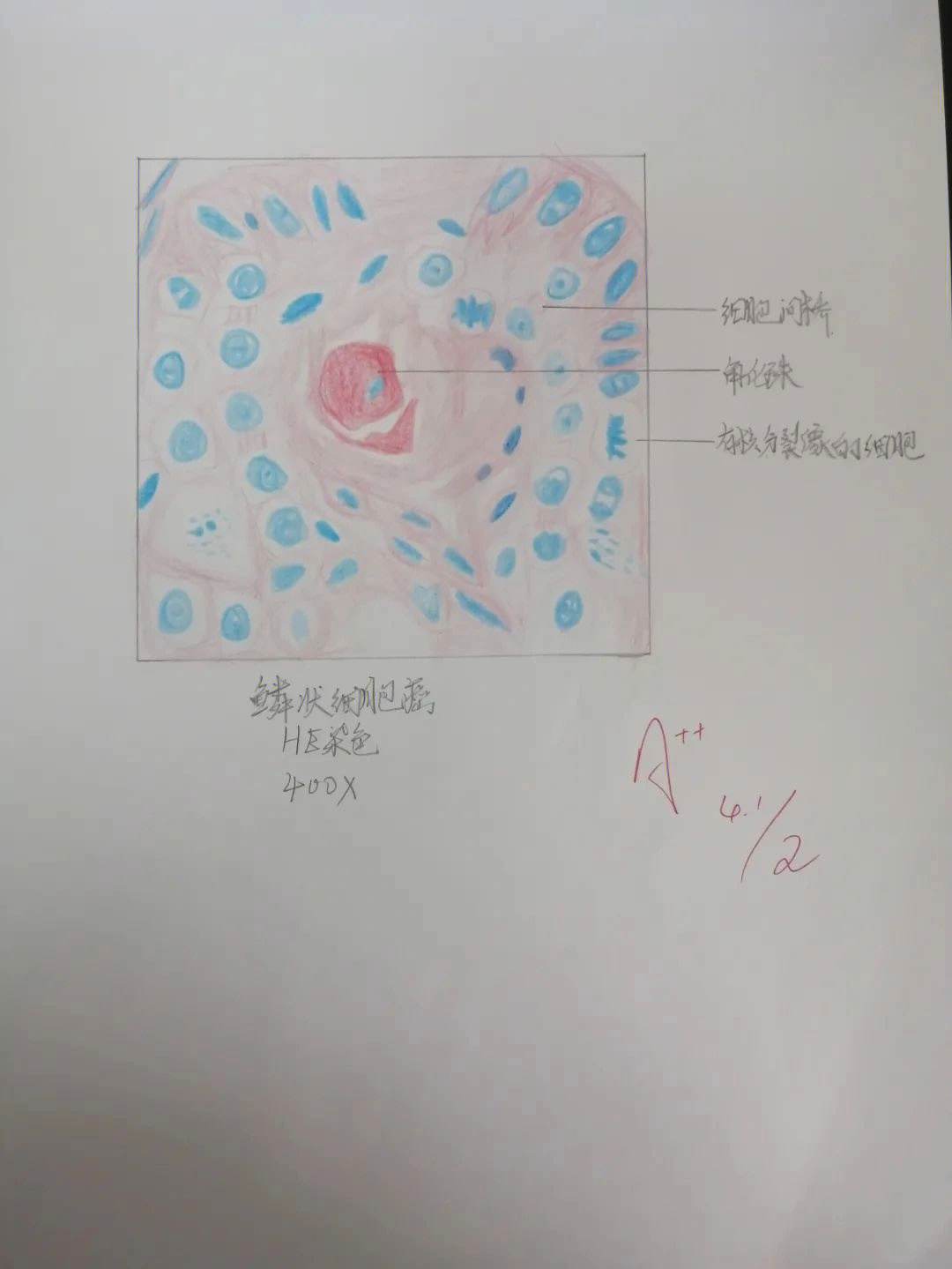 纤维肉瘤红蓝铅笔图图片