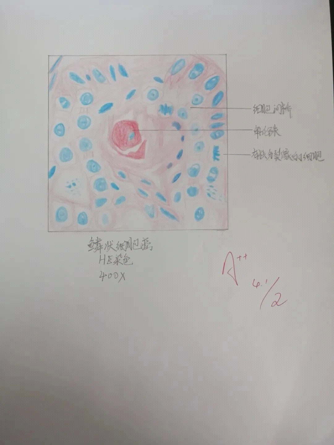 葡萄胎切片手绘图图片