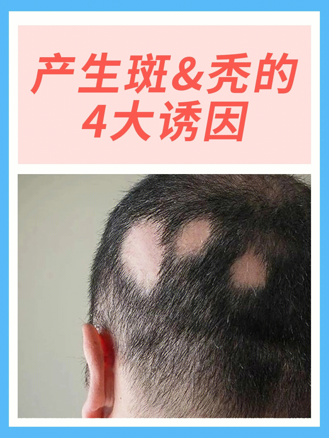 关于斑秃你不知道的事