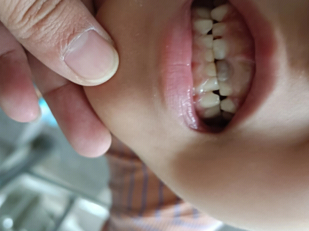 6015小朋友如果钙补充不足的话牙齿就会形成蜂窝样小坑牙釉质不