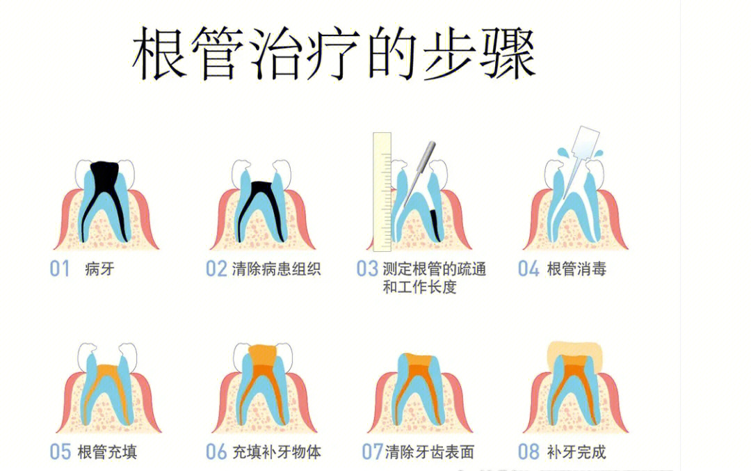 根管治疗要几次图片