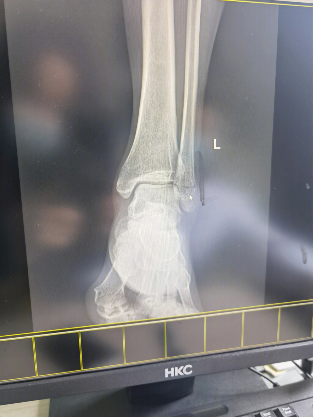 脚踝骨折2周走路图片