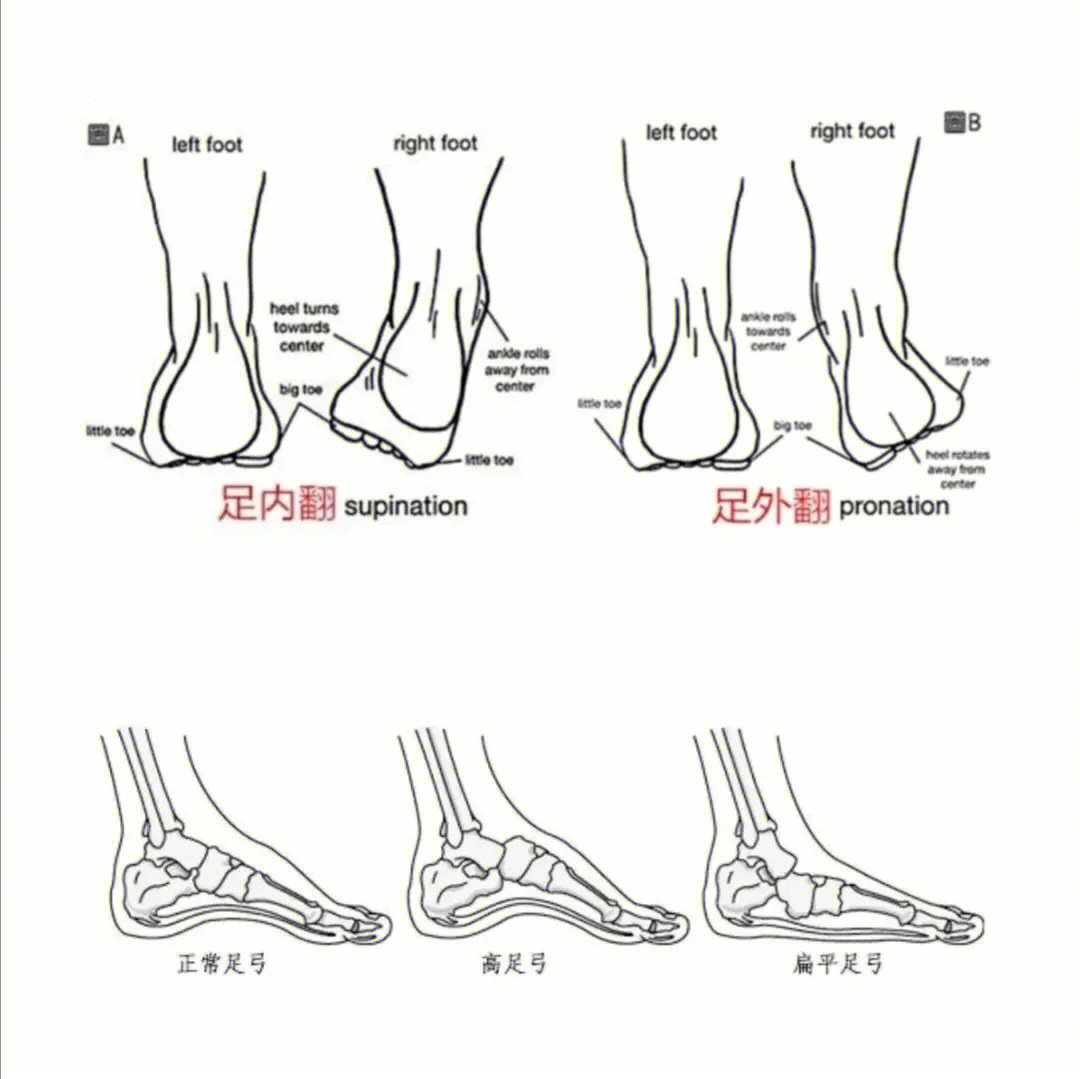 儿童足外翻怎么办图片