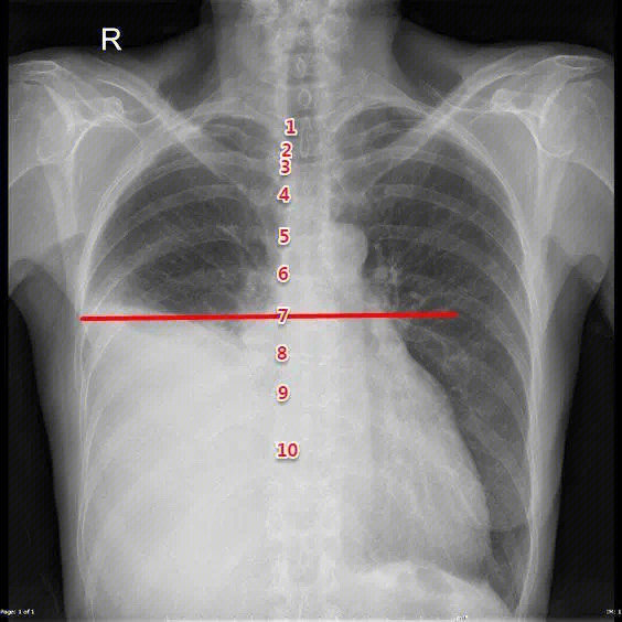 从胸片上定位胸腔积液量的大小.