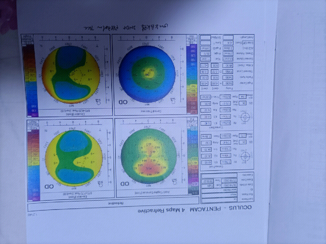 角膜地形图es值em值图片