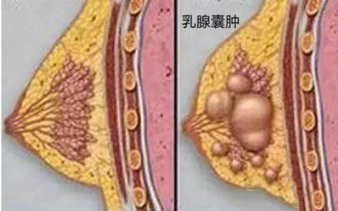 乳腺囊肿的症状图片