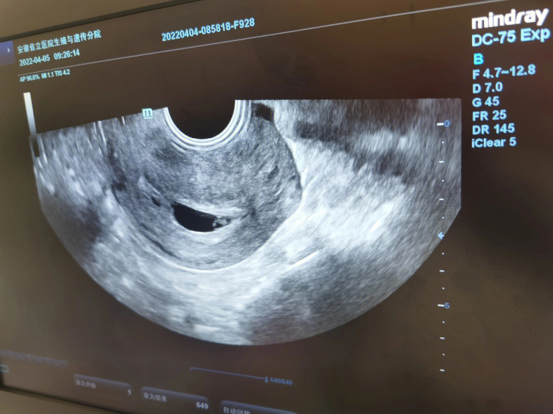 正常孕囊和卵黄囊图图片