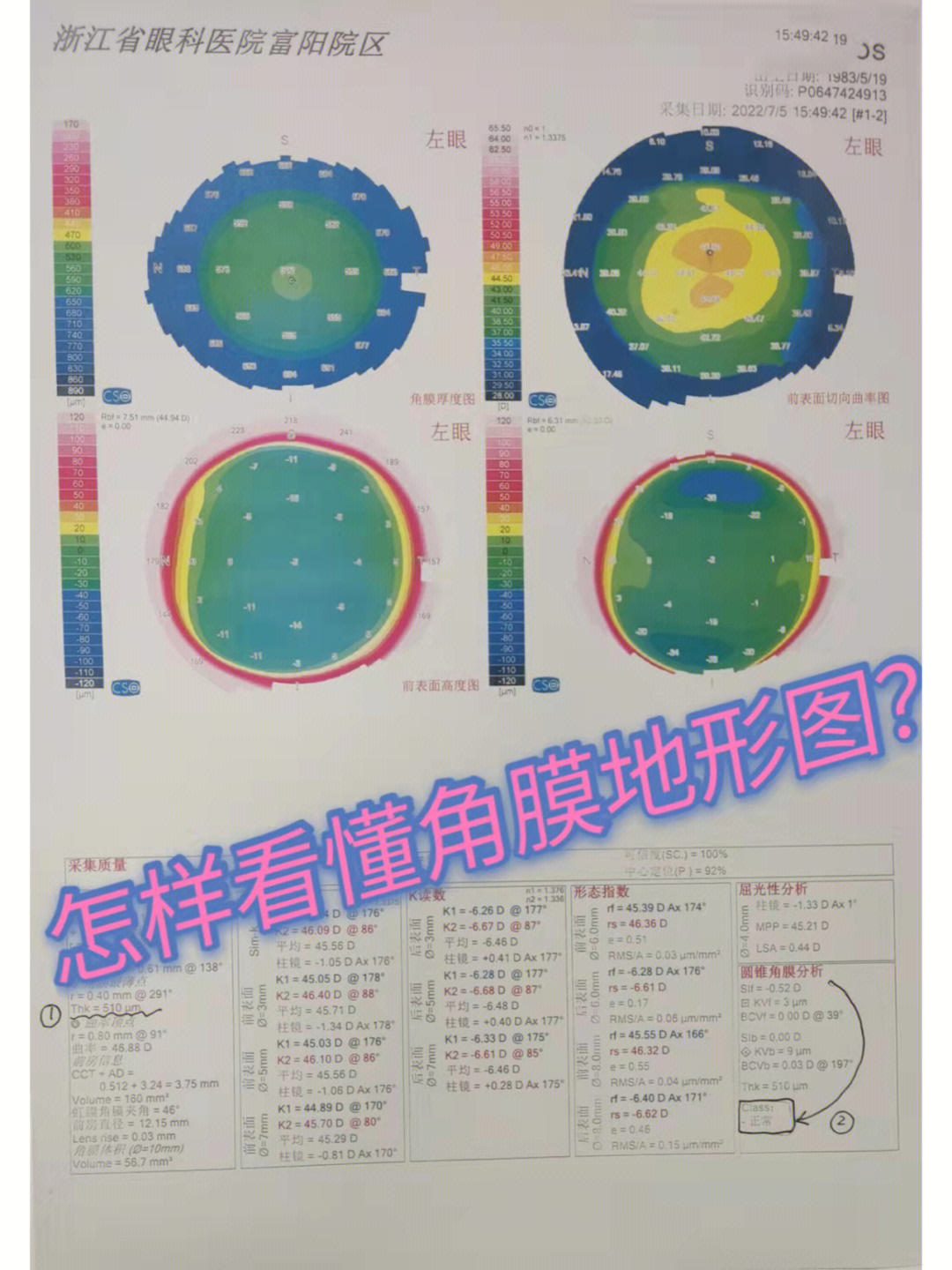 角膜地形图检查的目的图片