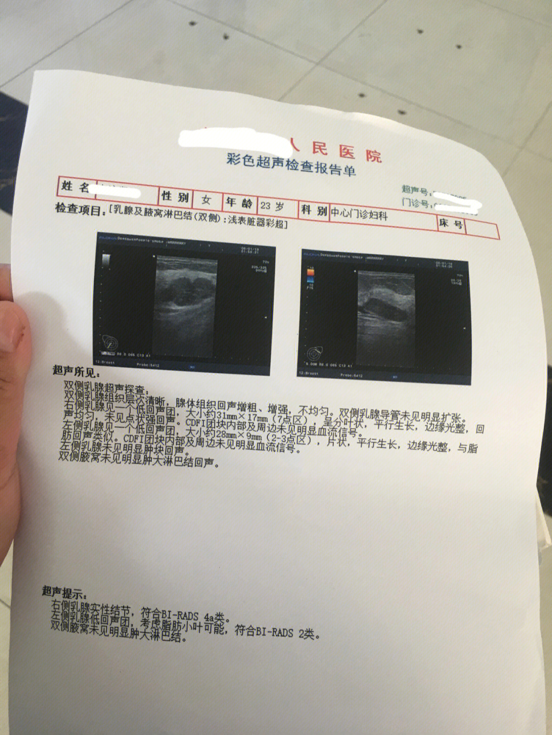 乳腺结节4a已经5年了图片