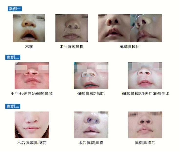 鼻软骨生长图片