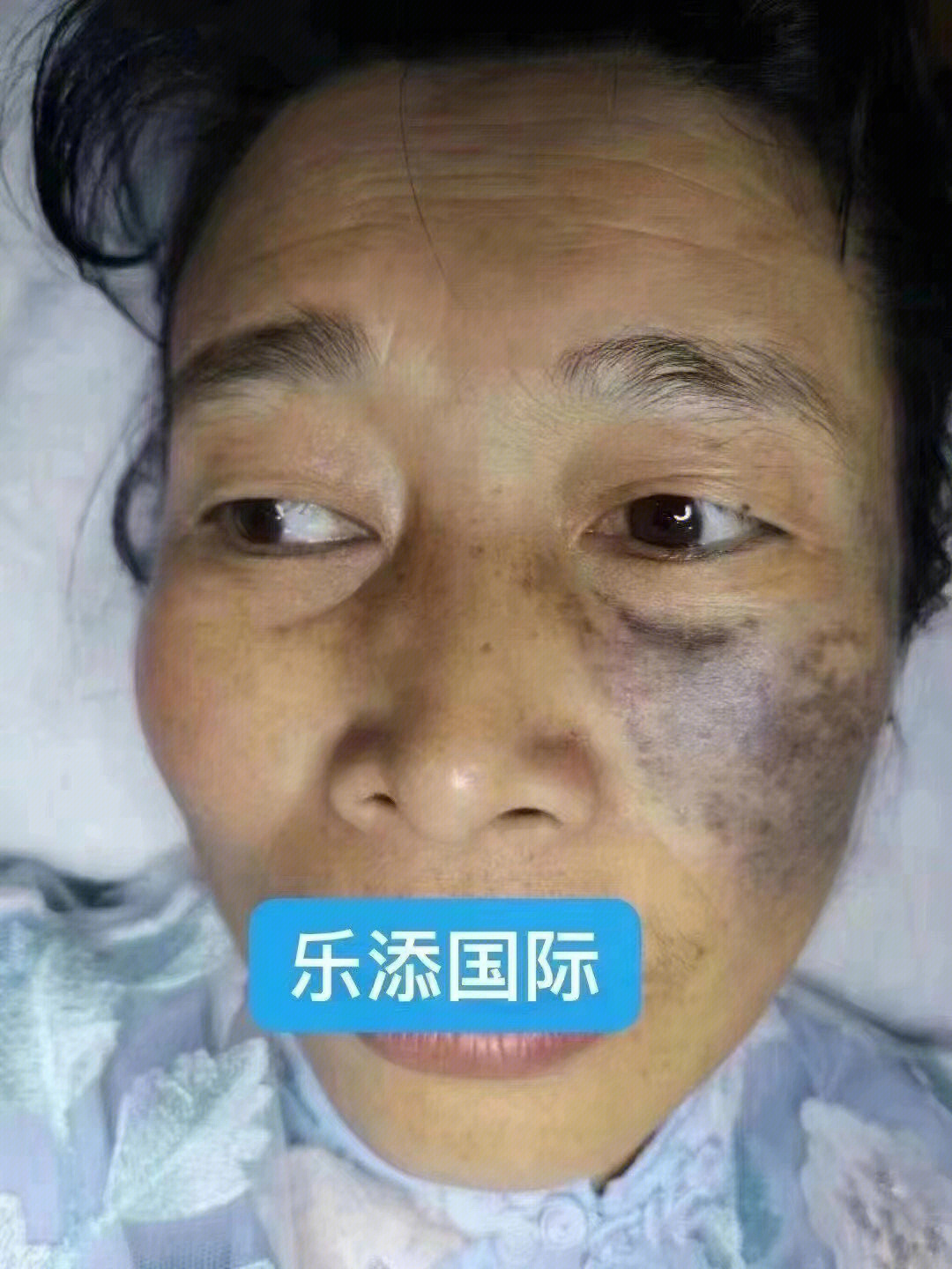 美丽是女人一辈子的事业治疗胎记