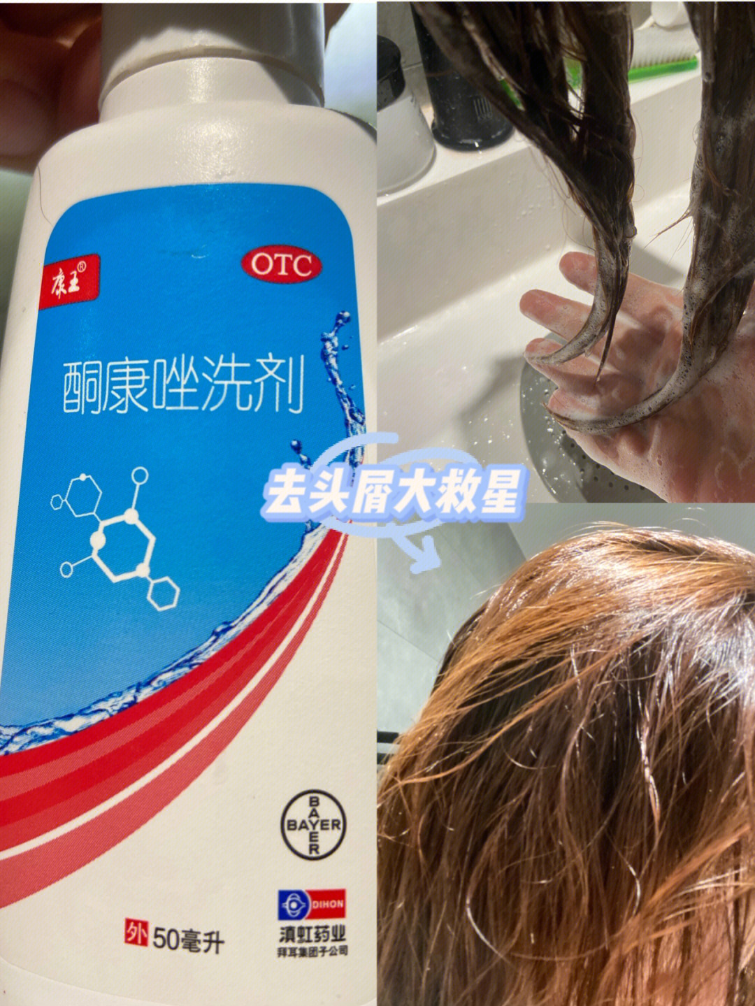 酮康唑洗发水副作用图片