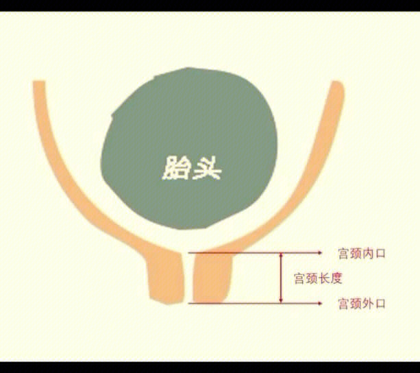 宫颈管长度参照表图片