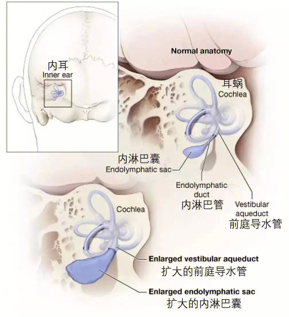 大前庭导水管综合征图片