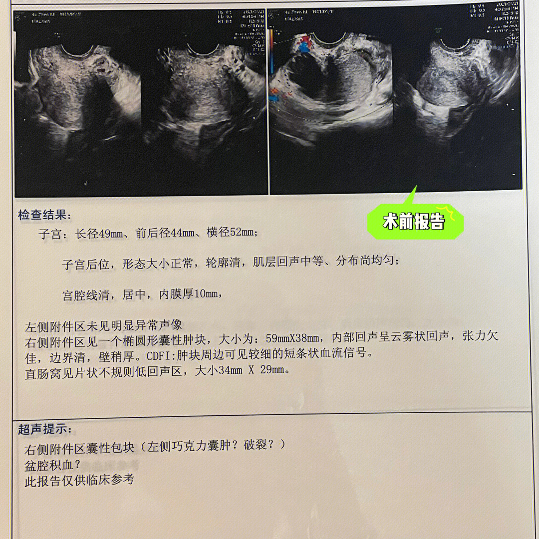 巧克力囊肿可以怀孕吗图片