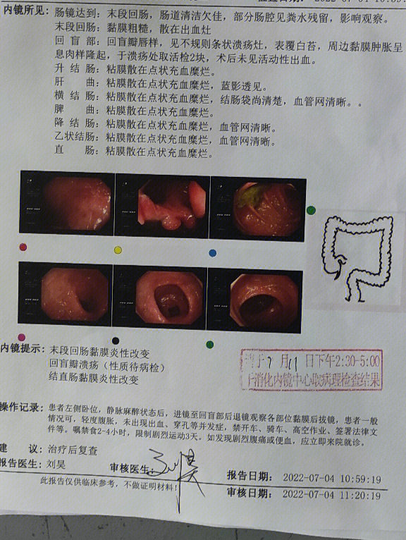 肠结核图片 肠镜检查图片