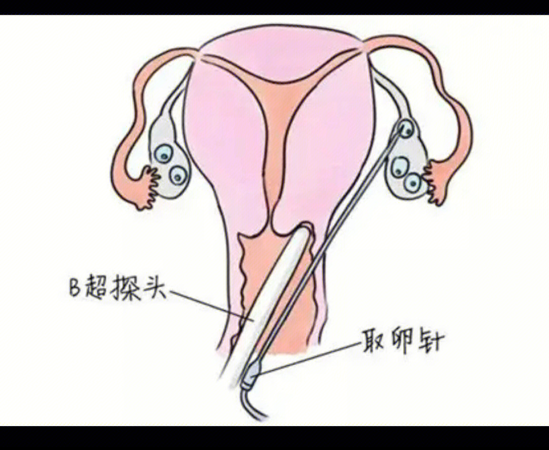 女性取卵过程图片