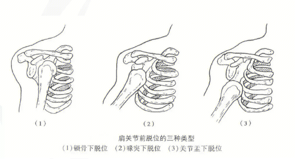 肩关节外旋复位法图解图片