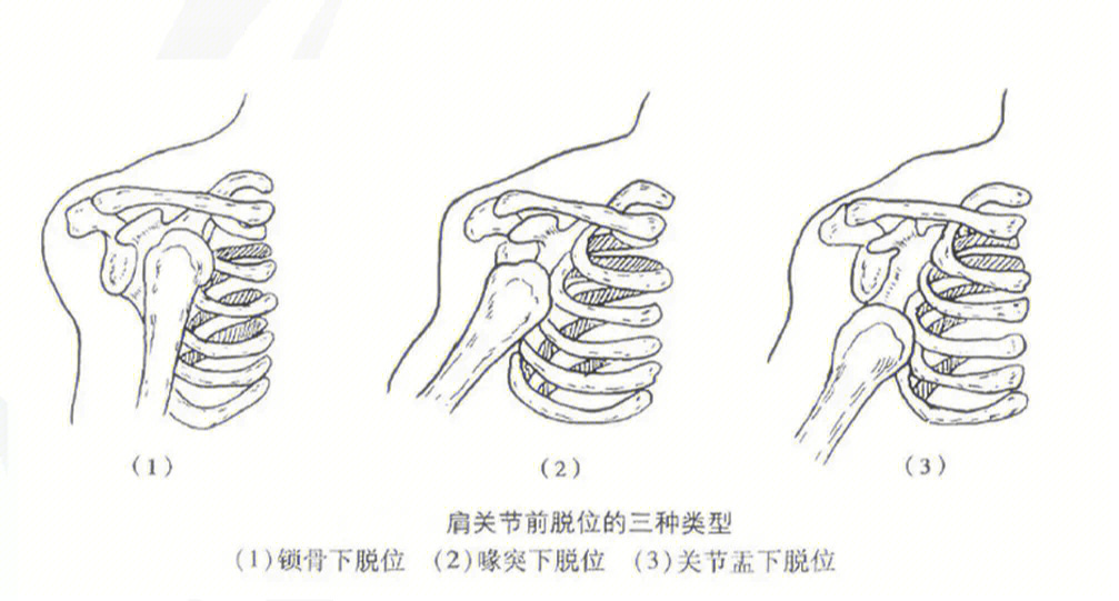 肩锁关节三级脱位图片