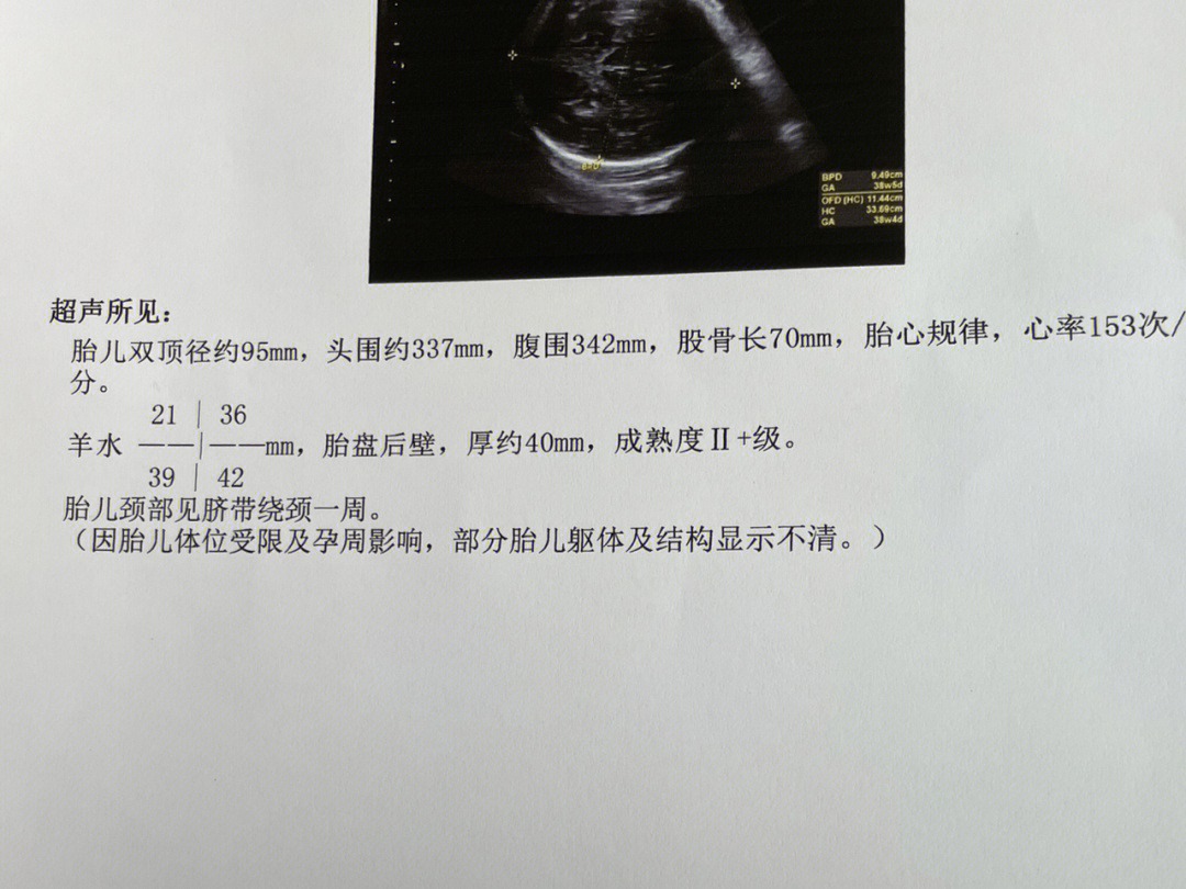 胎儿股骨短6周出生图片