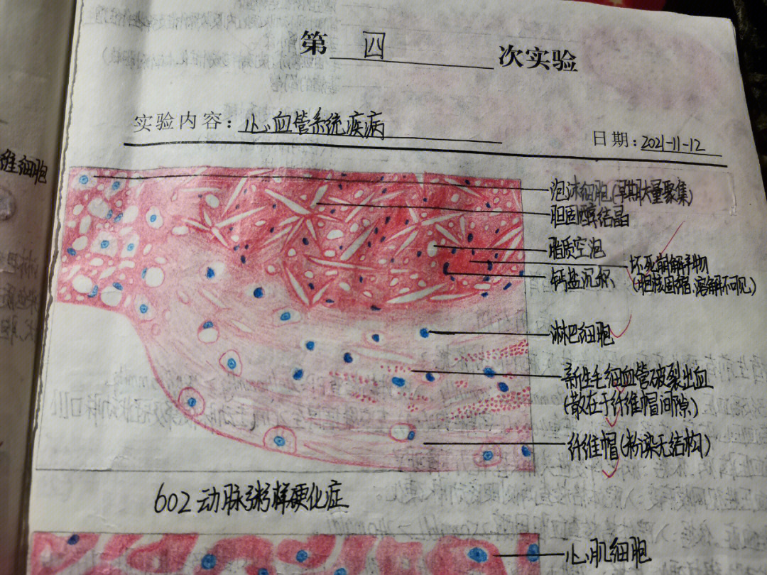 病理红蓝铅笔手绘图心血管系统疾病