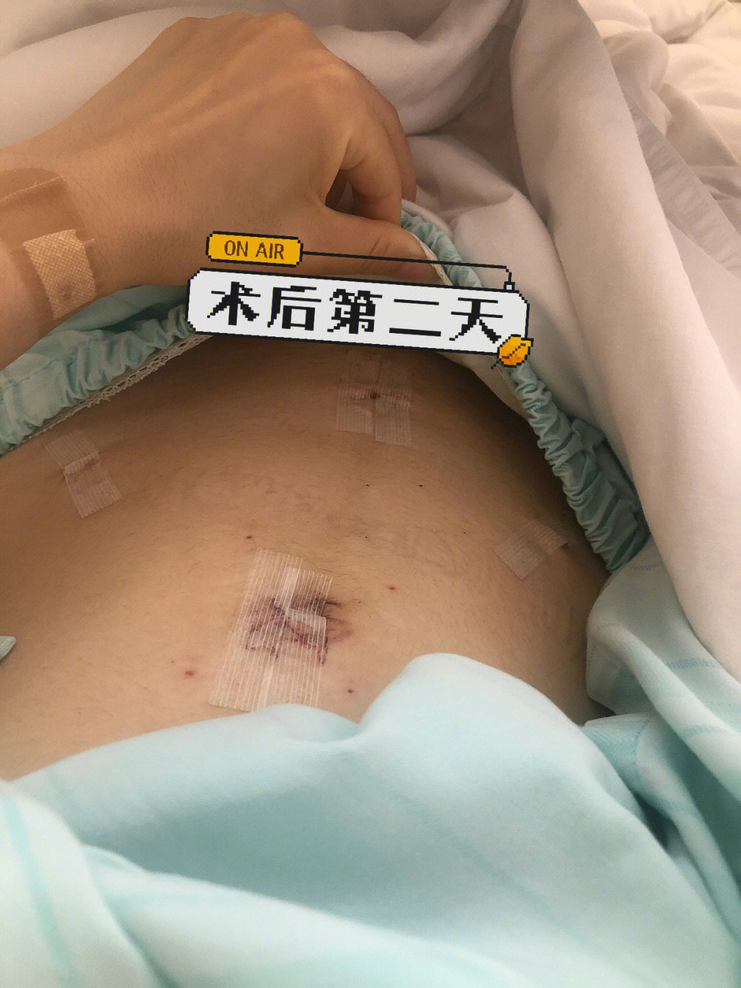 腹腔镜伤口恢复图 1月图片