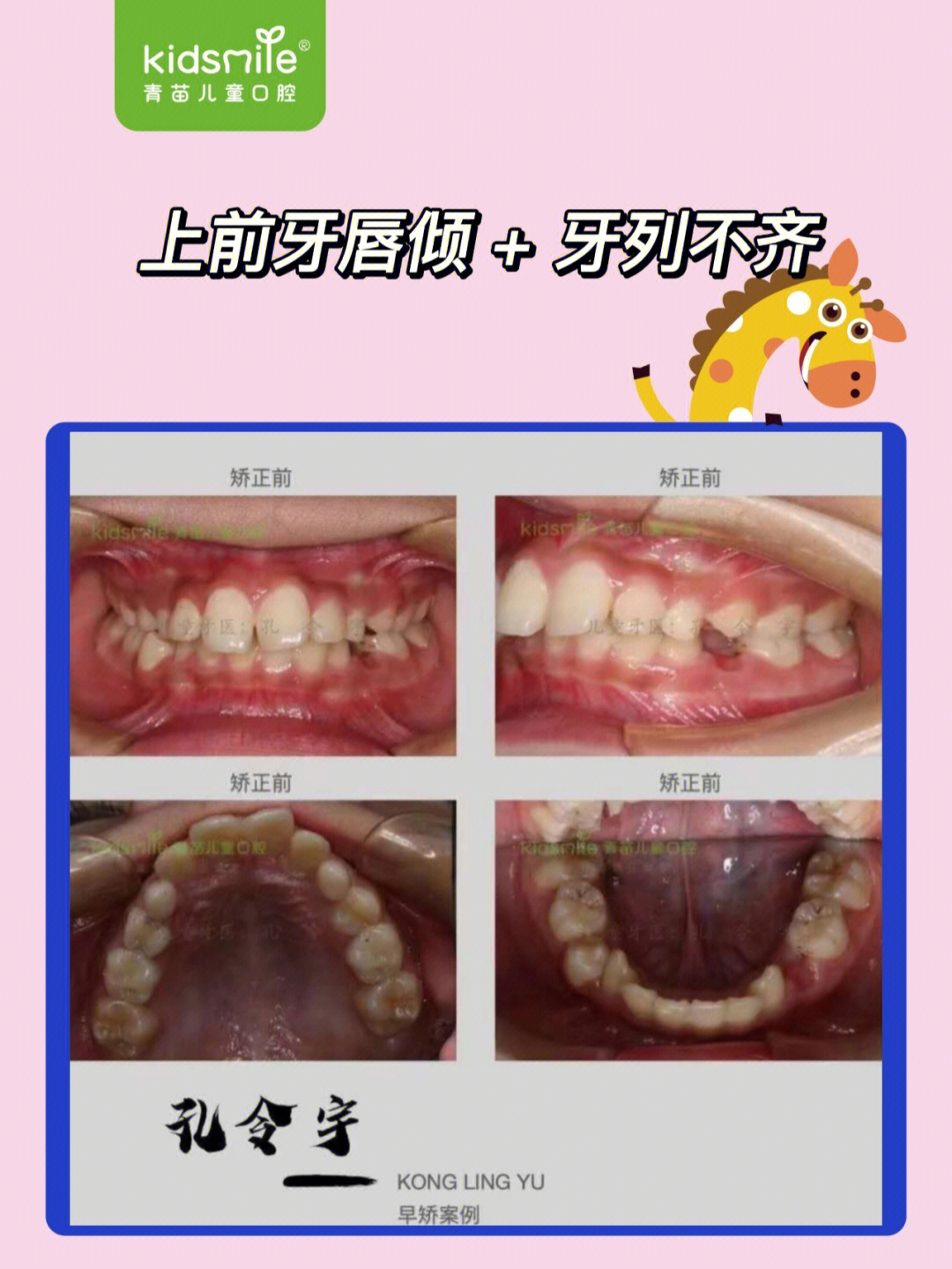 青苗案例上前牙唇倾77牙列不齐