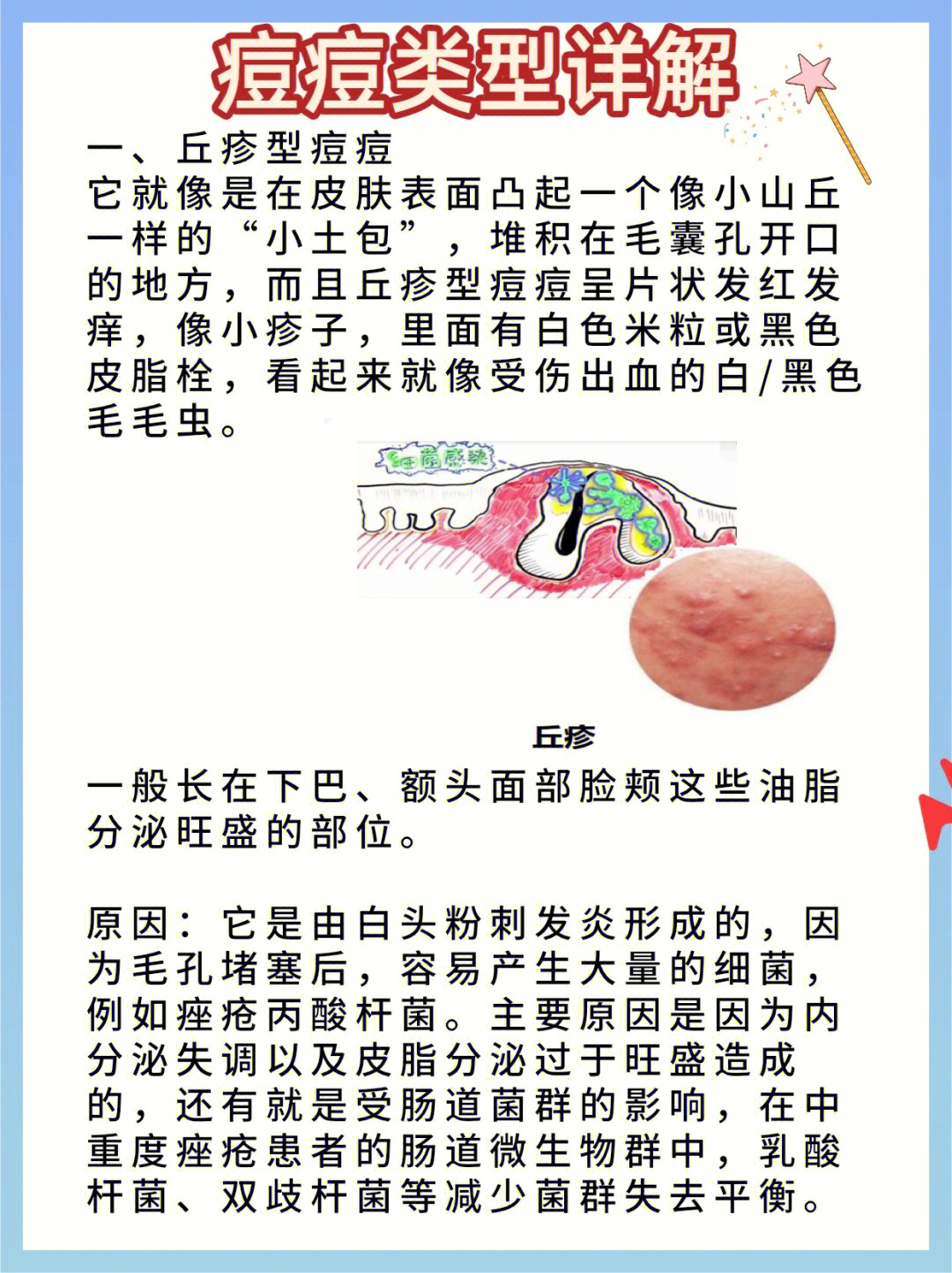 丘疹型痘痘能否自愈图片