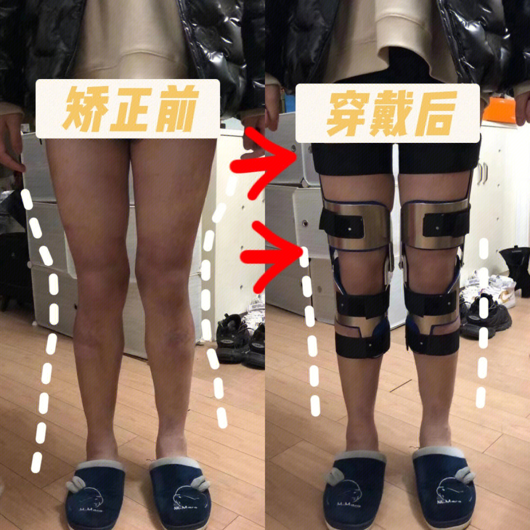 xo型腿矫正手术图片