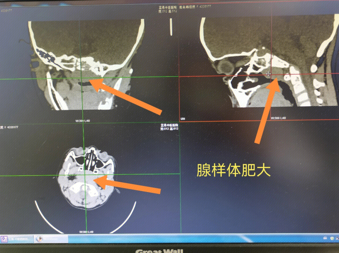 精索位置示意图CT图片