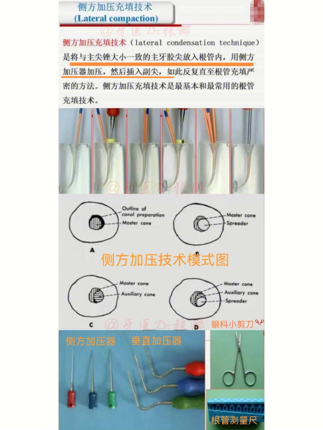 简单充填术图片