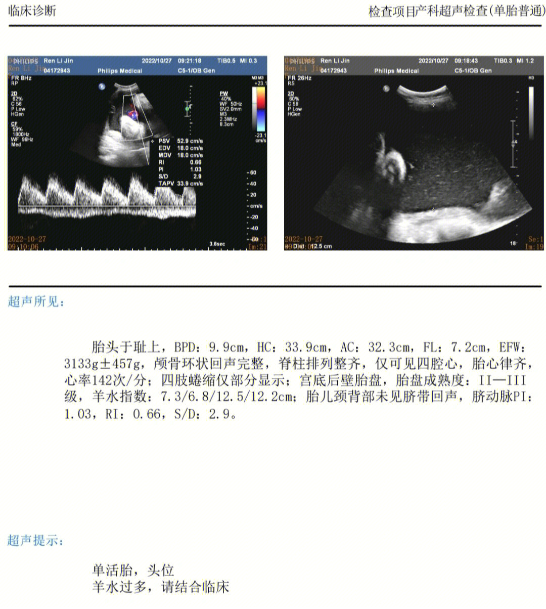 怀孕37周胎儿彩超图片