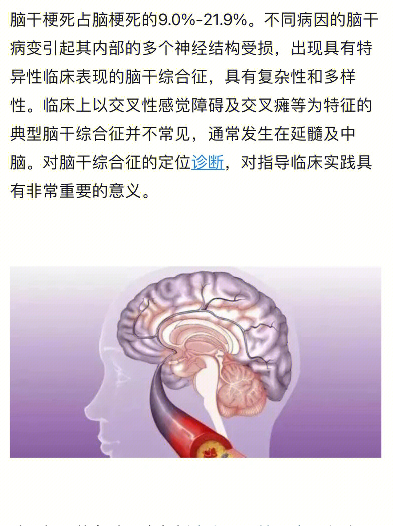 脑干梗死图片