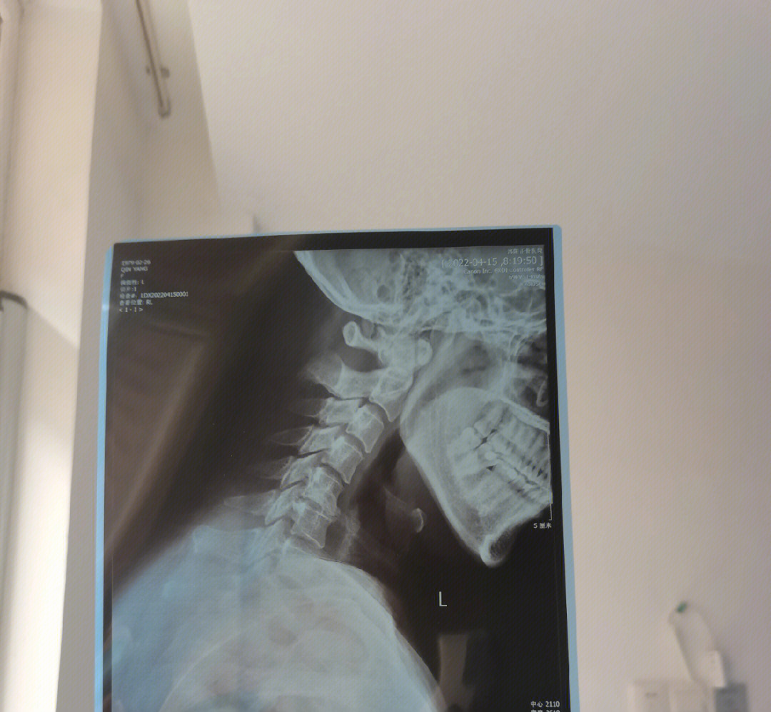 颈椎双斜位报告模板图片